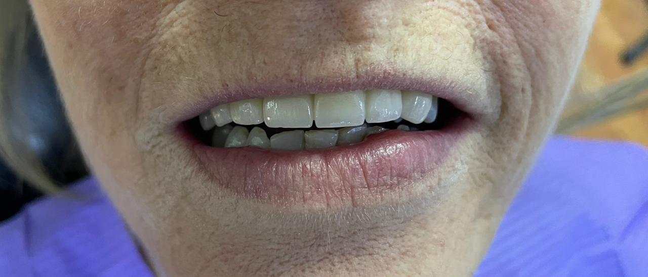 Después del puente de porcelana sobre implantes